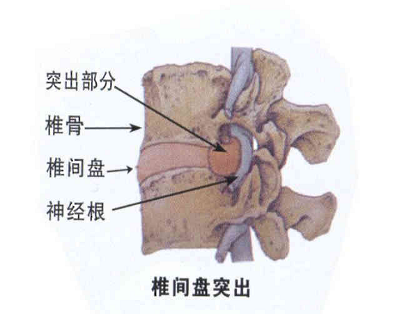 椎間盤突出