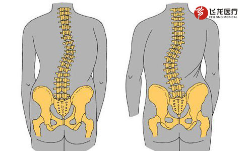 脊柱側彎