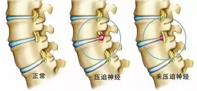 椎間盤病變對(duì)比