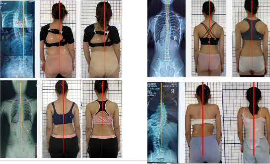 脊柱側(cè)彎治療