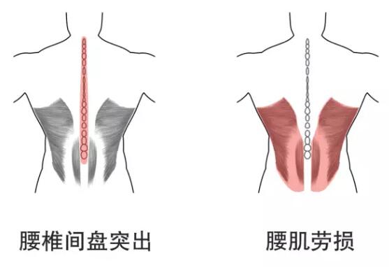 腰椎間盤突出腰肌勞損