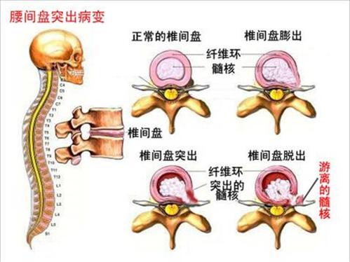 椎間盤突出癥