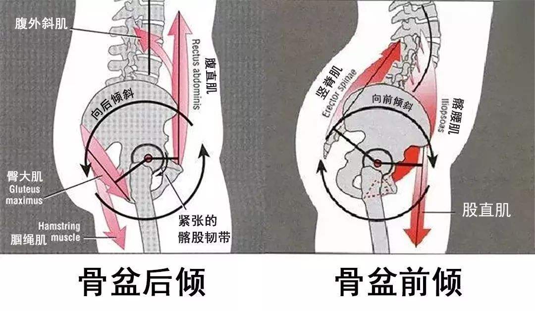 骨盆后傾